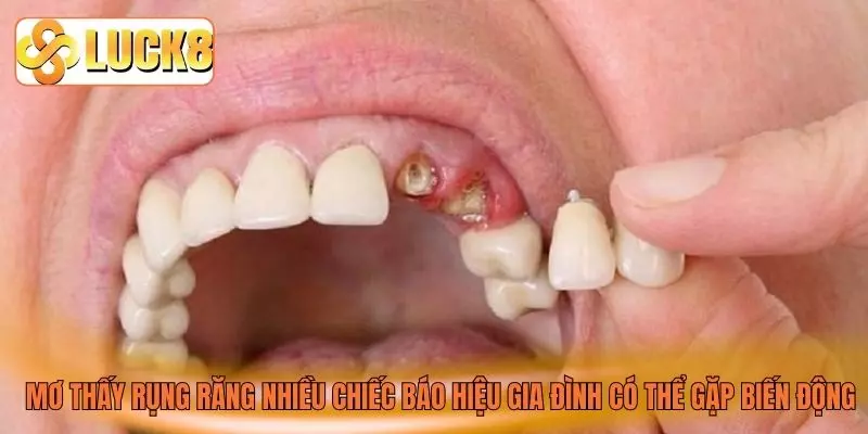 Mơ thấy rụng răng nhiều chiếc báo hiệu gia đình có thể gặp biến động Mơ thấy rụng răng nhiều chiếc báo hiệu gia đình có thể gặp biến động